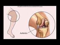 Natural Remedies for Arthritis in Children