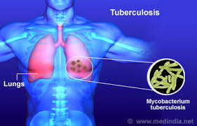 Tubercolosis (T.B)