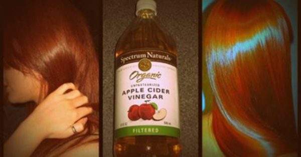 Home Remedies For Dandruff : APPLE CIDER VINEGAR