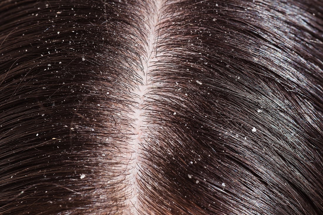 Dandruff – Are You Sure It Dandruff?