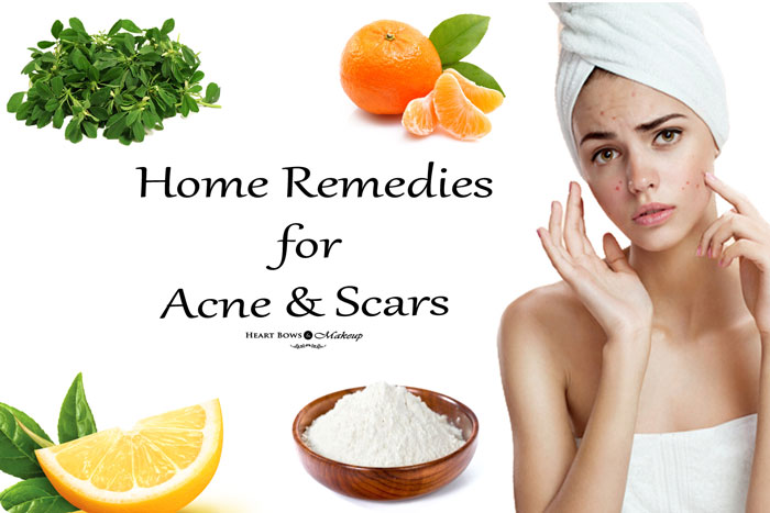 5 Natural and Non-Natural Acne Treatments