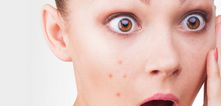 5 Tips For Getting Rid of Acne