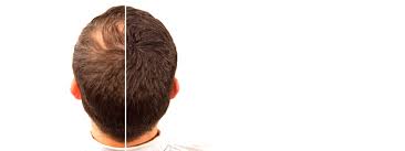 A Hair Loss Cure For Men