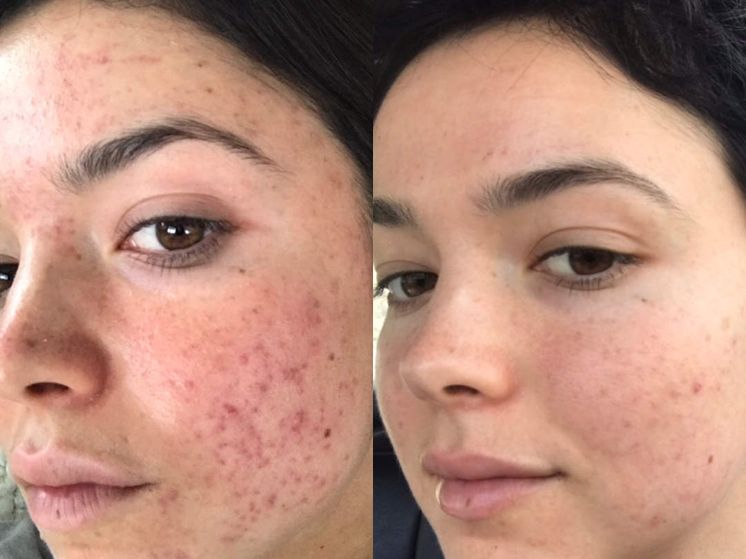 5 Tips To Cure Your Acne