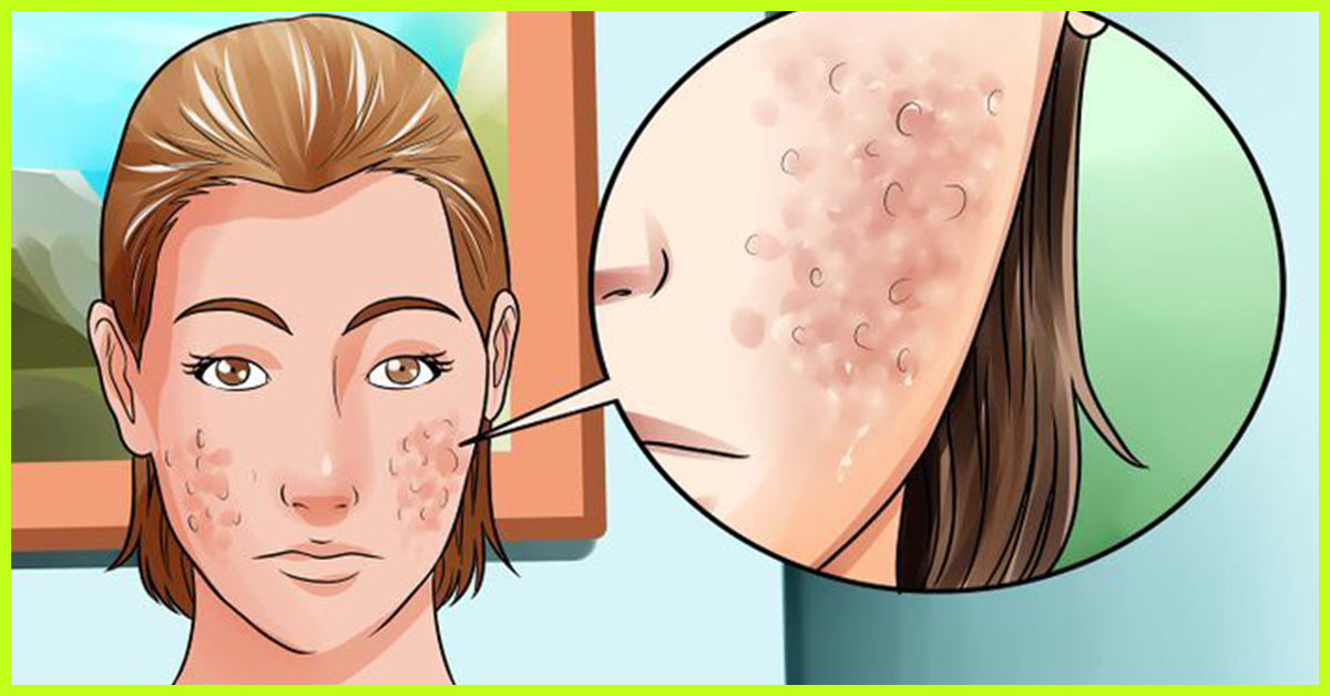 4 Simple Methods to Clear Up Acne Scars