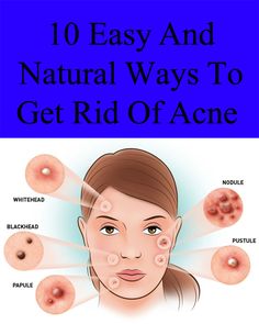 10 Easy and Natural Ways to Get Rid of Acne