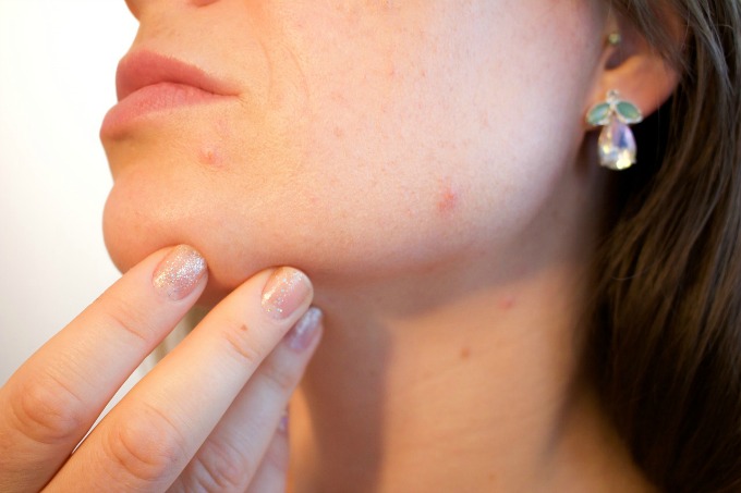 4 Tips on How to Treat Adult Acne