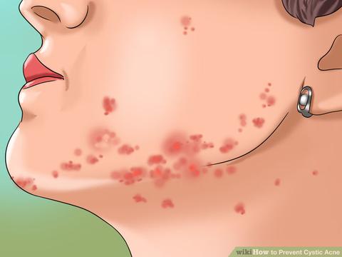 5 Recommended Medication Remedies to Treat Cystic Acne