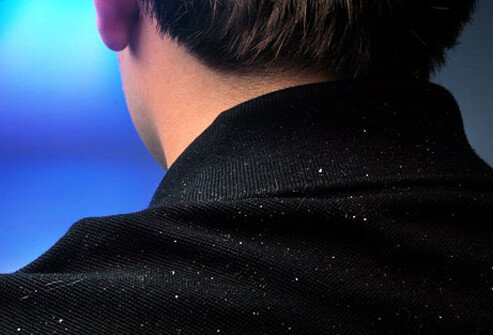 Dandruff – What Causes Dandruff?