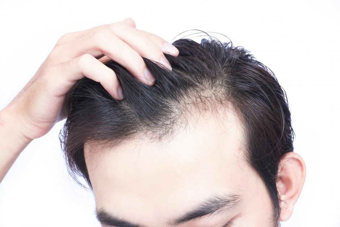 Common Causes of Hair Loss