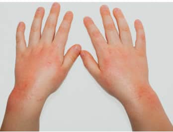 Home Remedies for Eczema Scars