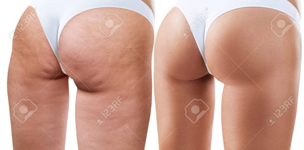 Home Remedies for Cellulitis