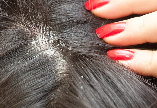 Home Remedies for Dandruff