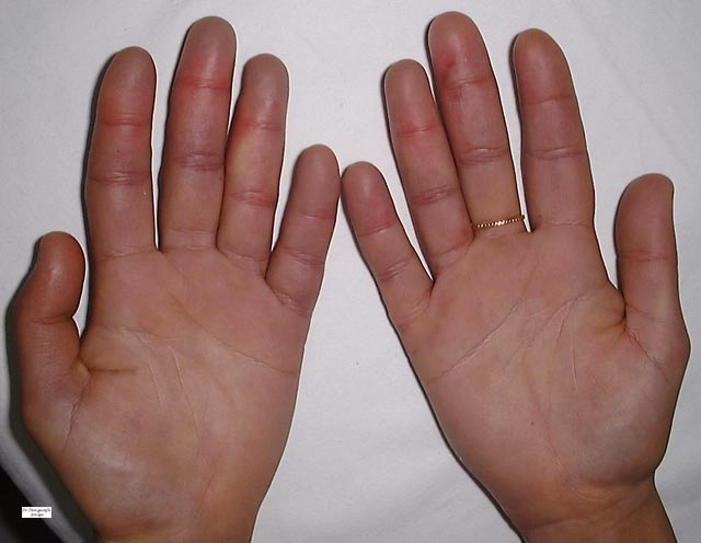 Home Remedies for Dermatitis