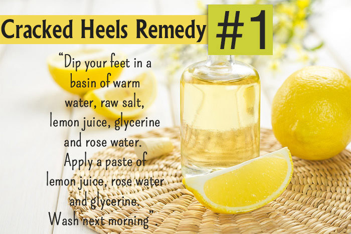 Home Remedies for Cracked Heels