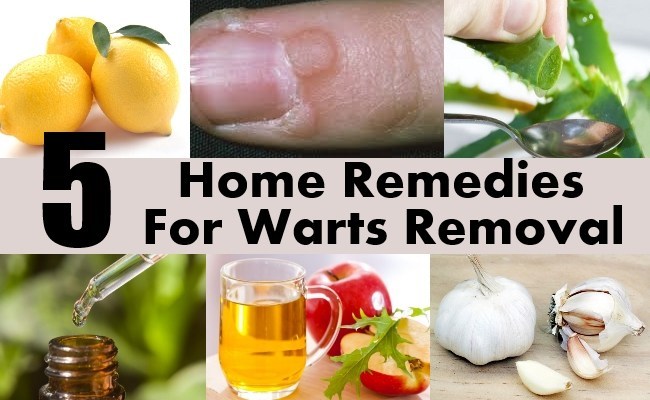 Home Remedies for Warts
