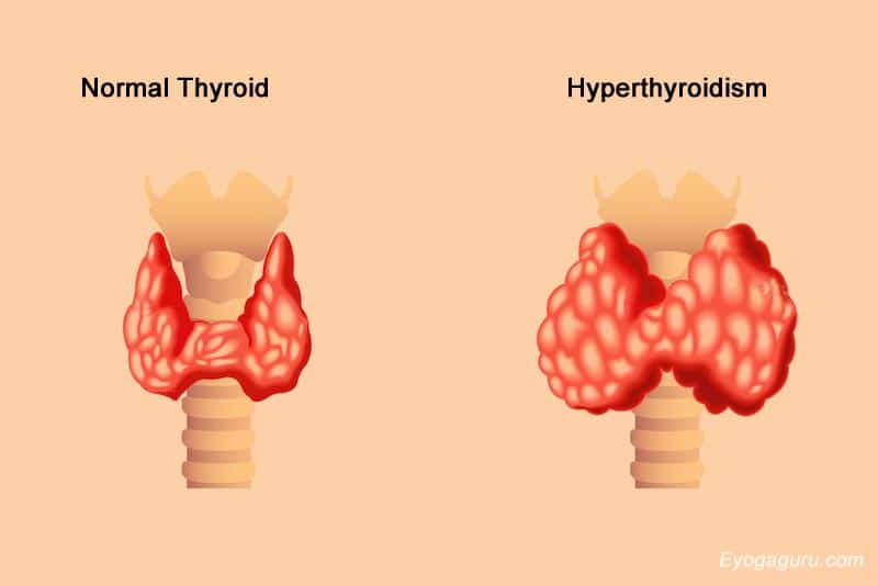 Home Remedies for Hyperthyroidism