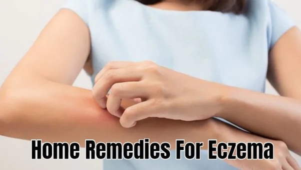 Home Remedies for Eczema