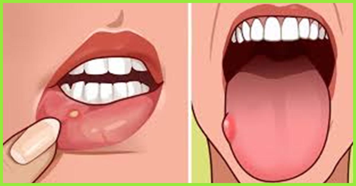 Home Remedies for a Sore Tongue