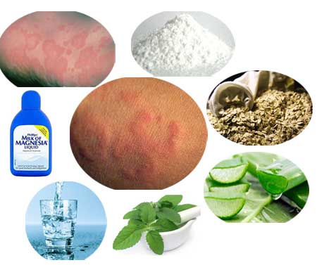 Home Remedies for Hives