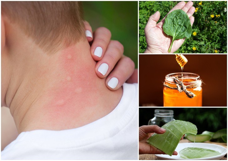 Home Remedies for Mosquito Bites