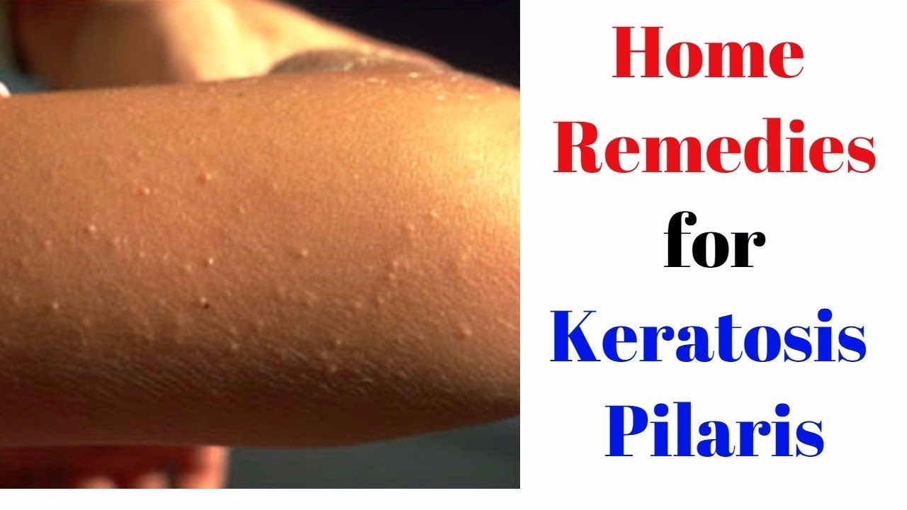 Home Remedies for Keratosis Pilaris (Bumps on the Skin)