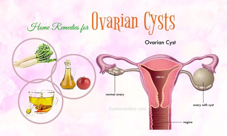 Home Remedies for Ovarian Cysts