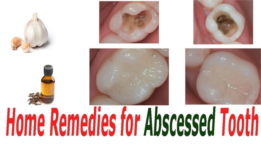 Home Remedies for an Abscessed Tooth