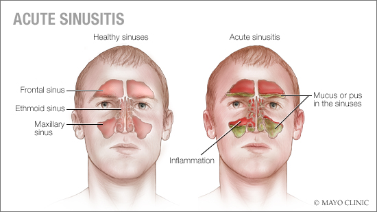 Home Remedies for Acute Sinusitis