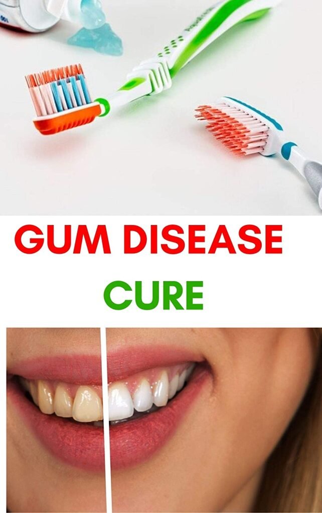 Home Remedies for Gum Disease