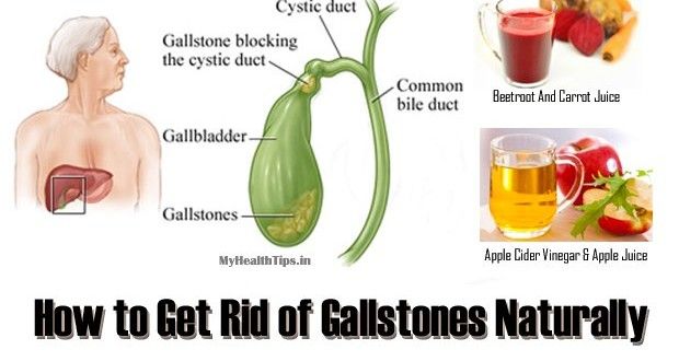 Home Remedies for Gallstones