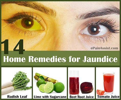 Home Remedies for Jaundice