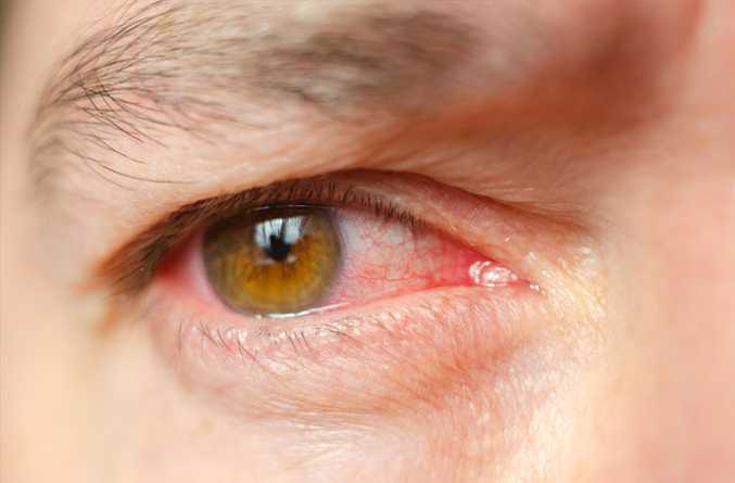 Home Remedies for Eye Infections