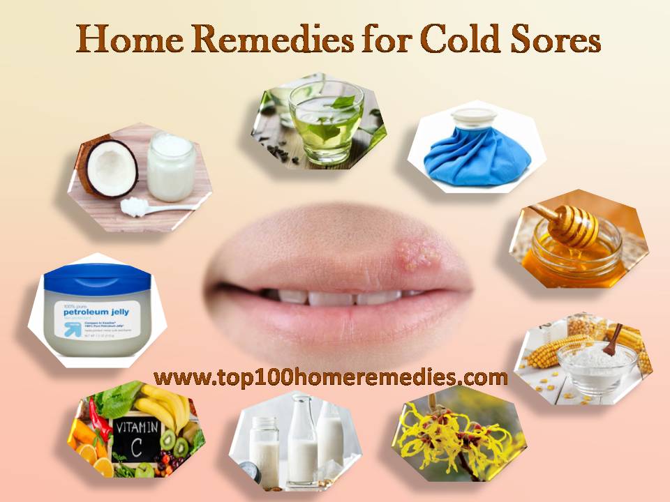 Home Remedies for Cold Sores