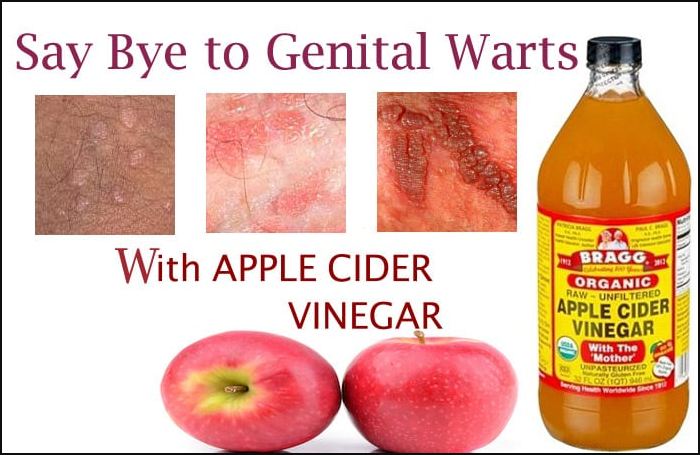 Home Remedies for Genital Warts
