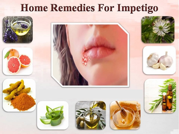 Home Remedies for Impetigo