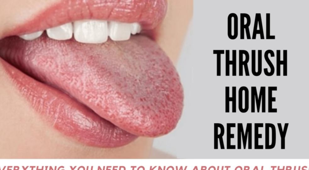 Home Remedies for Oral Thrush