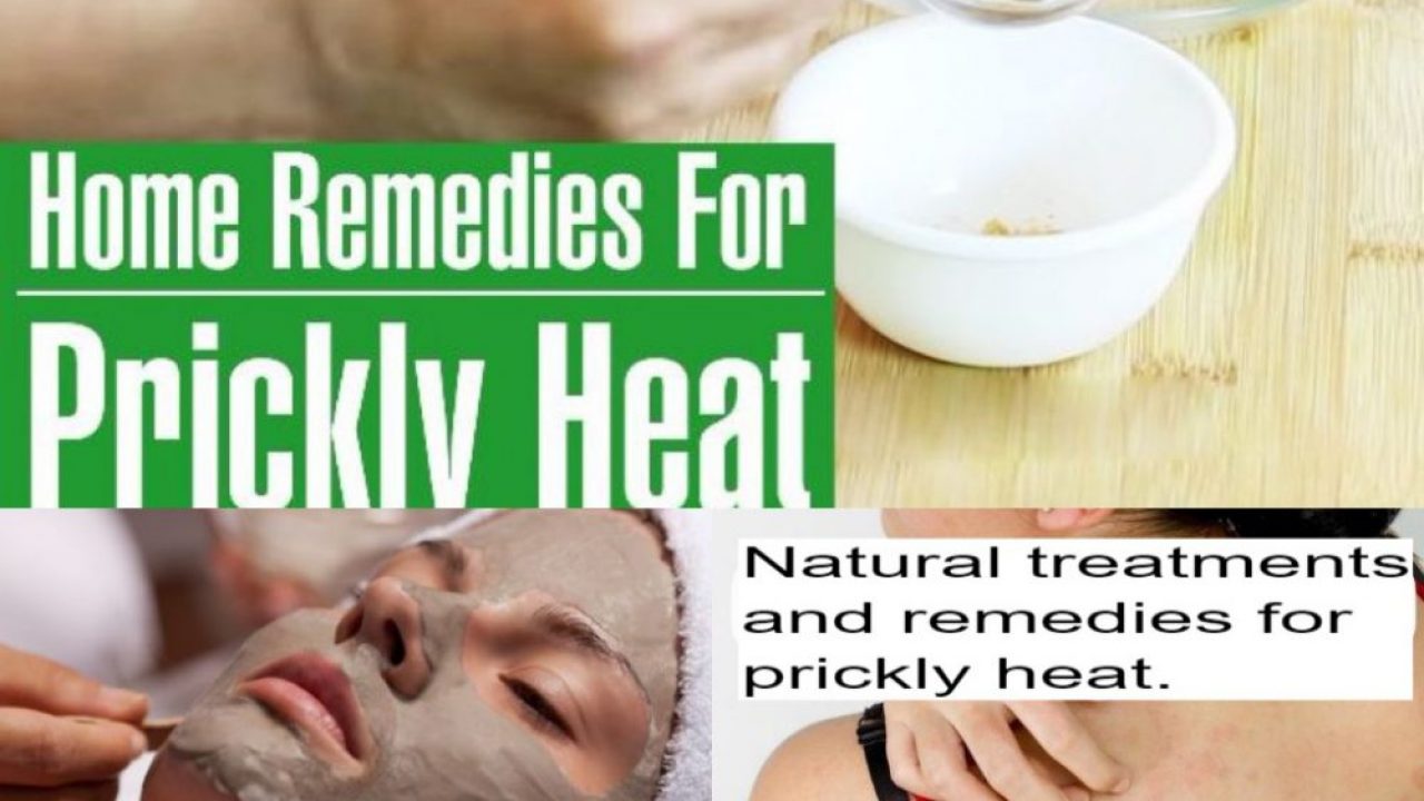 Home Remedies for Prickly Heat