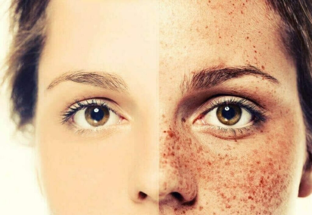 Home Remedies to Get Rid Of Freckles