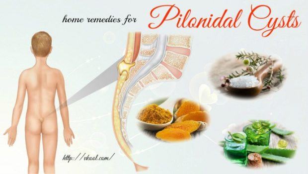 Home Remedies for Pilonidal Cysts