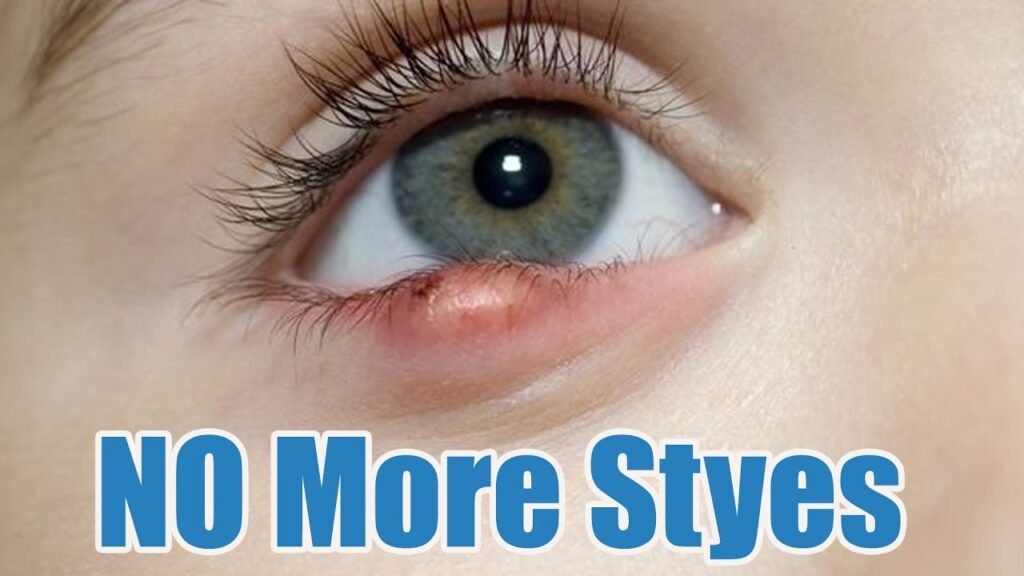 Home Remedies for Eye Sty (Stye)