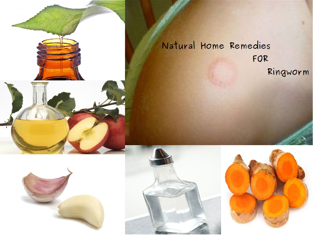 Home Remedies for Ringworm
