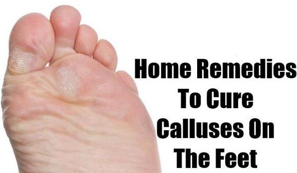 Home Remedies for Calluses on Feet