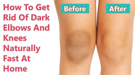 Home Remedies for Dark Elbows and Knees