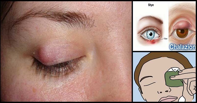 Home Remedies for Eyelid Cysts (Chalazions)