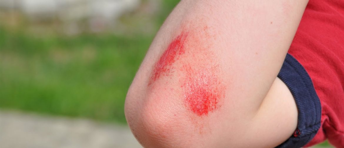 Home Remedies for Minor Cuts and Grazes