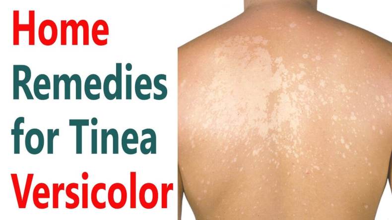 Home Remedies for Tinea Versicolor
