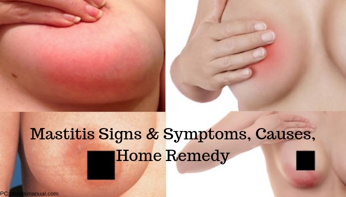 Home Remedies for Breast Infection (Mastitis)