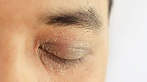 “Anti-Aging Eye Treatments: Natural Remedies for Dark Circles and Wrinkles”