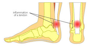 “Achilles Tendonitis Hot and Cold Therapy: Soothing Compresses for Pain Relief”